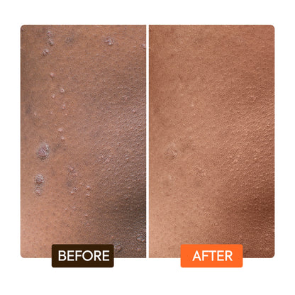 Carrot Toning Glycerin helps fade stretch marks